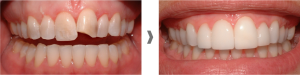 Carillas dentales sin rebajar el diente en Martorell