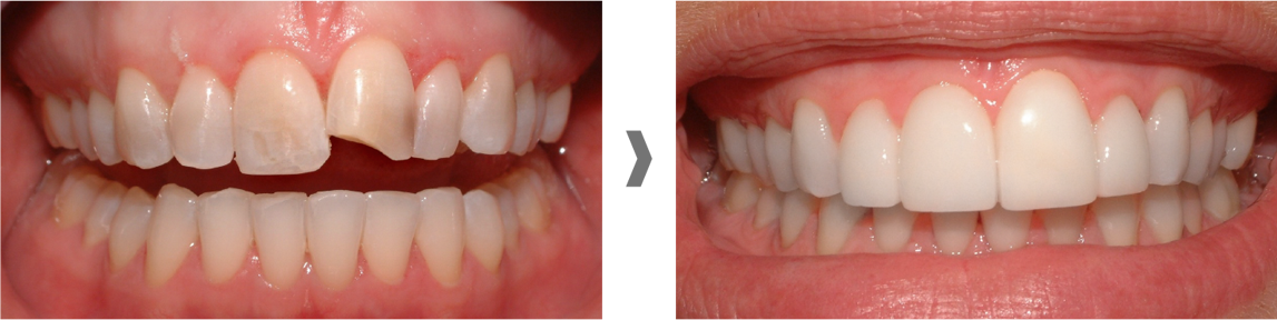 Carillas dentales sin rebajar el diente en Martorell