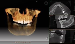 dentadura fijada con implantes dentales en Martorell