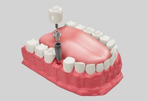 Implantes dentales de carga inmediata en Martorell