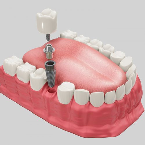 Implantes dentales de carga inmediata en Martorell