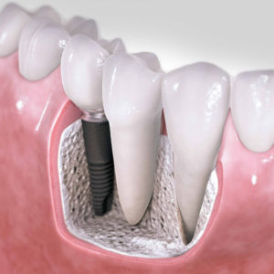 implantes dentales en Martorell