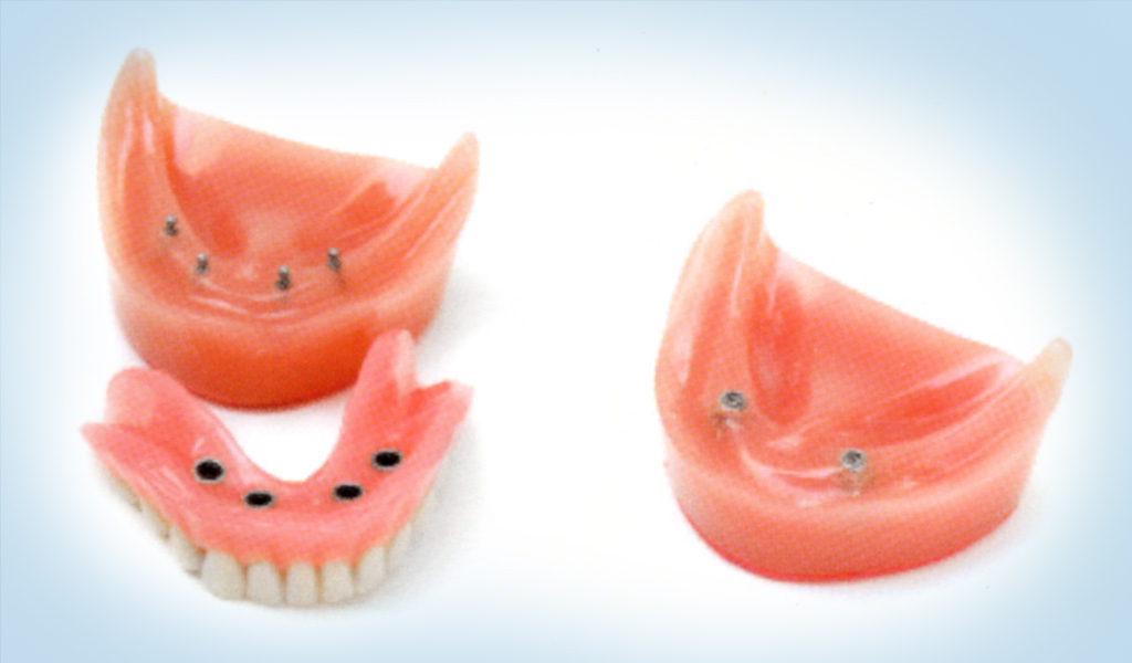 implantes dentales en Martorell