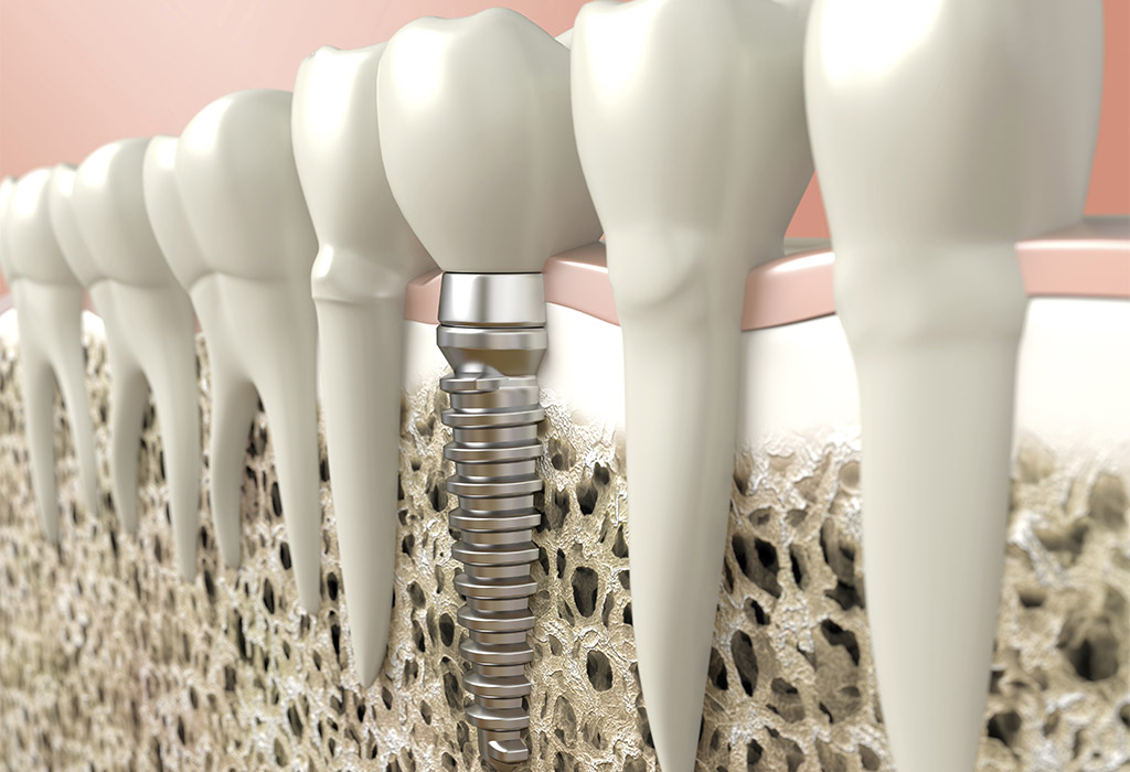 Implantología dental en Martorell