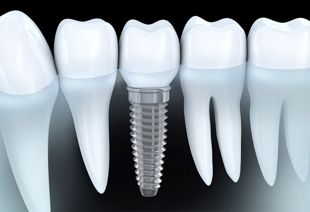 Implantología dental en Martorell