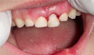 Urgencias dentales en Martorell